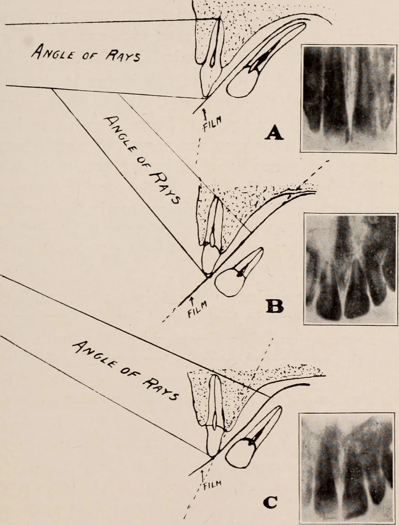 An illustration from Dental and oral radiography : a text book for students and practitioners of dentistry, 1916, leaf 90