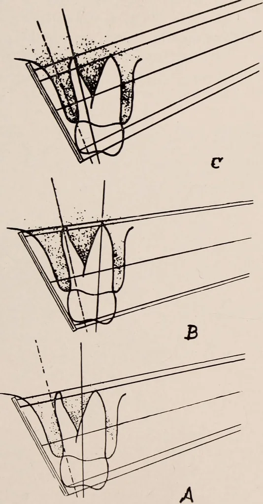 An illustration from Dental and oral radiography : a text book for students and practitioners of dentistry, 1916, leaf 92