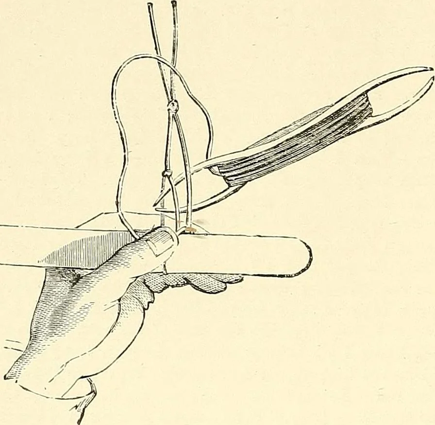 An illustration from The dictionary of needlework : an encyclopaedia of artistic, plain, and fancy needlework. Dealing fully with the details of all the stitches employed, the method of working, the materials used, the meaning of technical terms, and, where necessary, tracing the origin and history of the various works described. Illustrated with upwards of 800 wood engravings, and coloured plates. Plain sewing, textiles, dressmaking, appliances, and terms, 1885, leaf 89