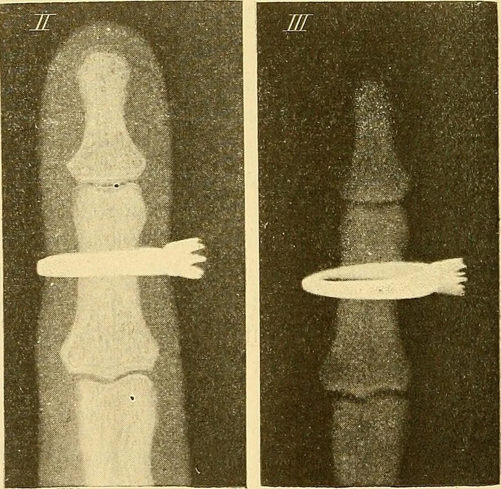 An illustration from Die Einrichtungen zur Erzeugung der Roentgenstrahlen und ihr Gebrauch : gemeinfasslich dargestellt insbesondere auch für Ärzte und Kliniken, 1899, leaf 160