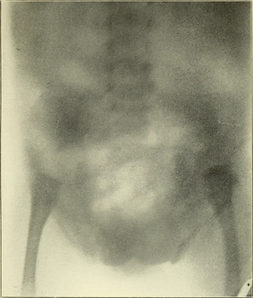 An illustration from Die Röntgenstrahlen im Dienste der Chirurgie, 1902, leaf 106