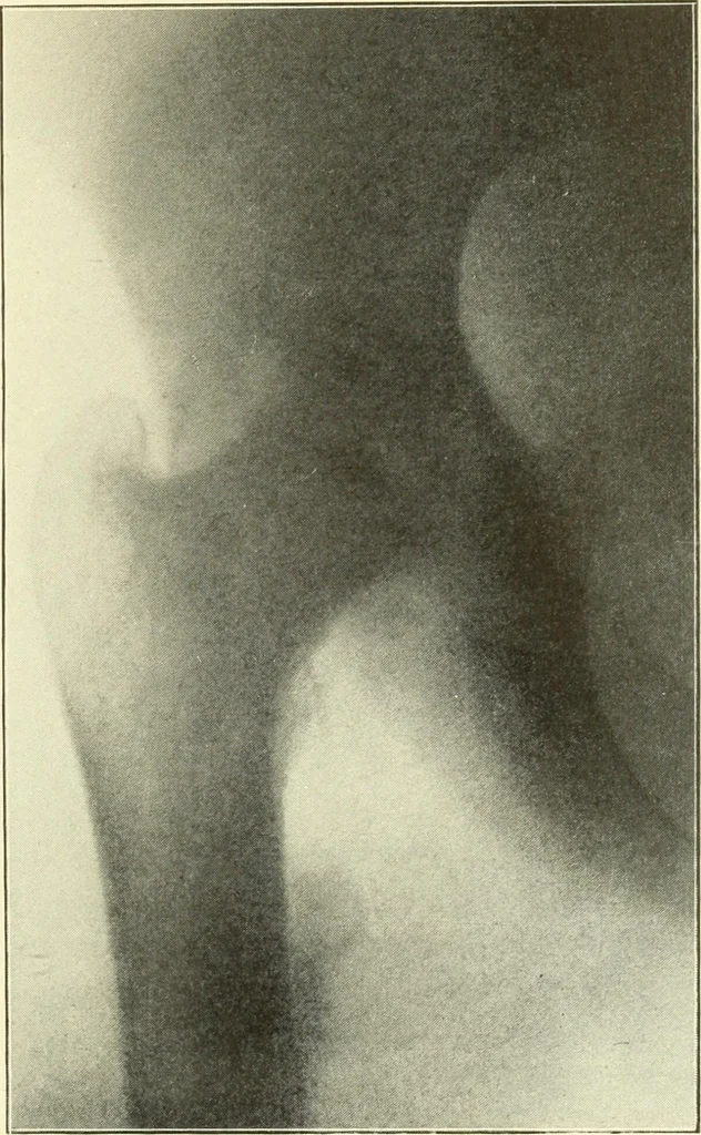 An illustration from Die Röntgenstrahlen im Dienste der Chirurgie, 1902, leaf 112