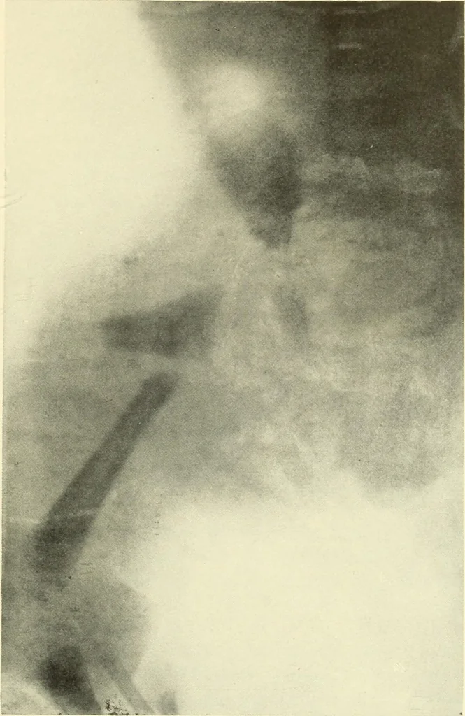 An illustration from Die Röntgenstrahlen im Dienste der Chirurgie, 1902, leaf 116