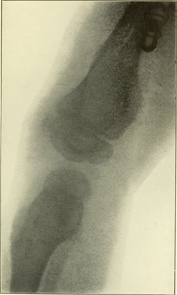 An illustration from Die Röntgenstrahlen im Dienste der Chirurgie, 1902, leaf 122