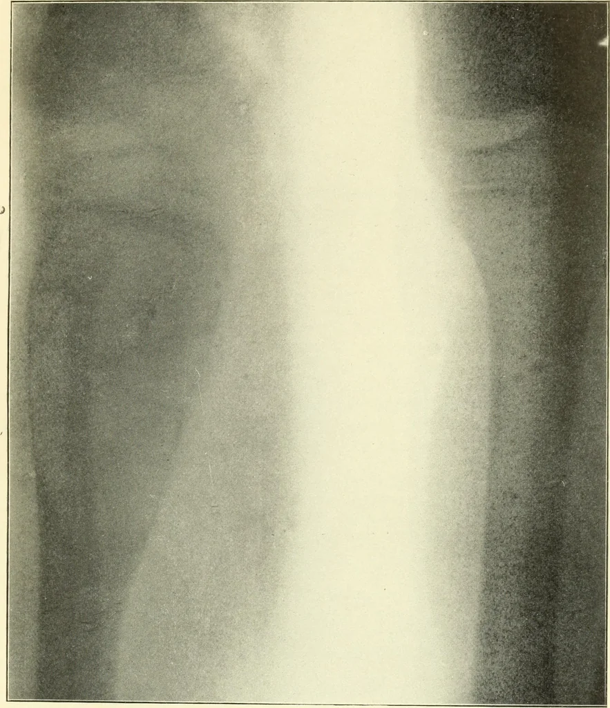 An illustration from Die Röntgenstrahlen im Dienste der Chirurgie, 1902, leaf 124