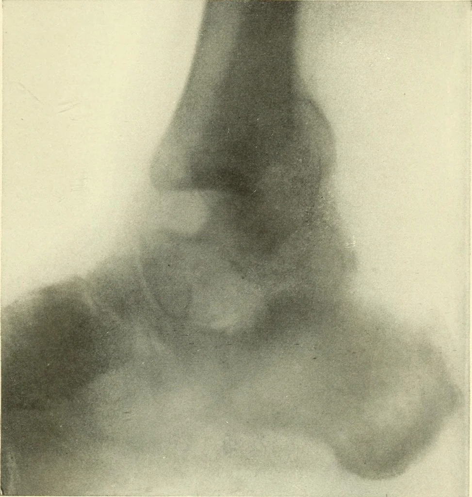 An illustration from Die Röntgenstrahlen im Dienste der Chirurgie, 1902, leaf 128