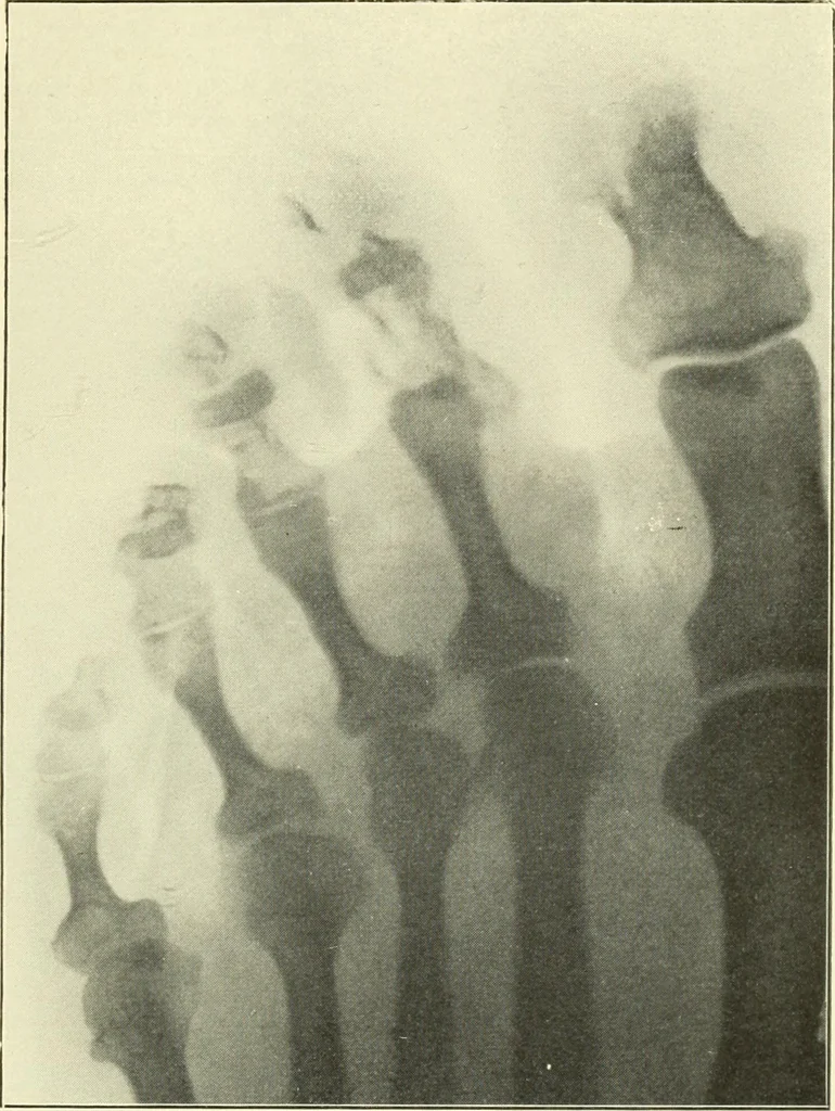 An illustration from Die Röntgenstrahlen im Dienste der Chirurgie, 1902, leaf 140