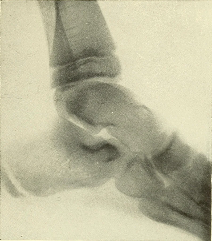 An illustration from Die Röntgenstrahlen im Dienste der Chirurgie, 1902, leaf 142