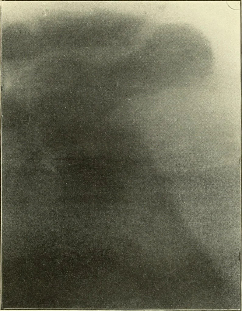 An illustration from Die Röntgenstrahlen im Dienste der Chirurgie, 1902, leaf 146