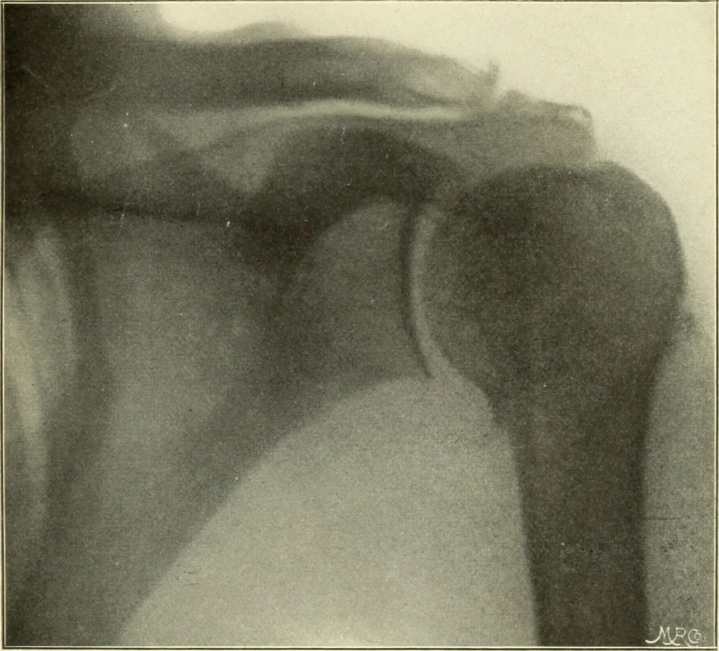 An illustration from Die Röntgenstrahlen im Dienste der Chirurgie, 1902, leaf 152