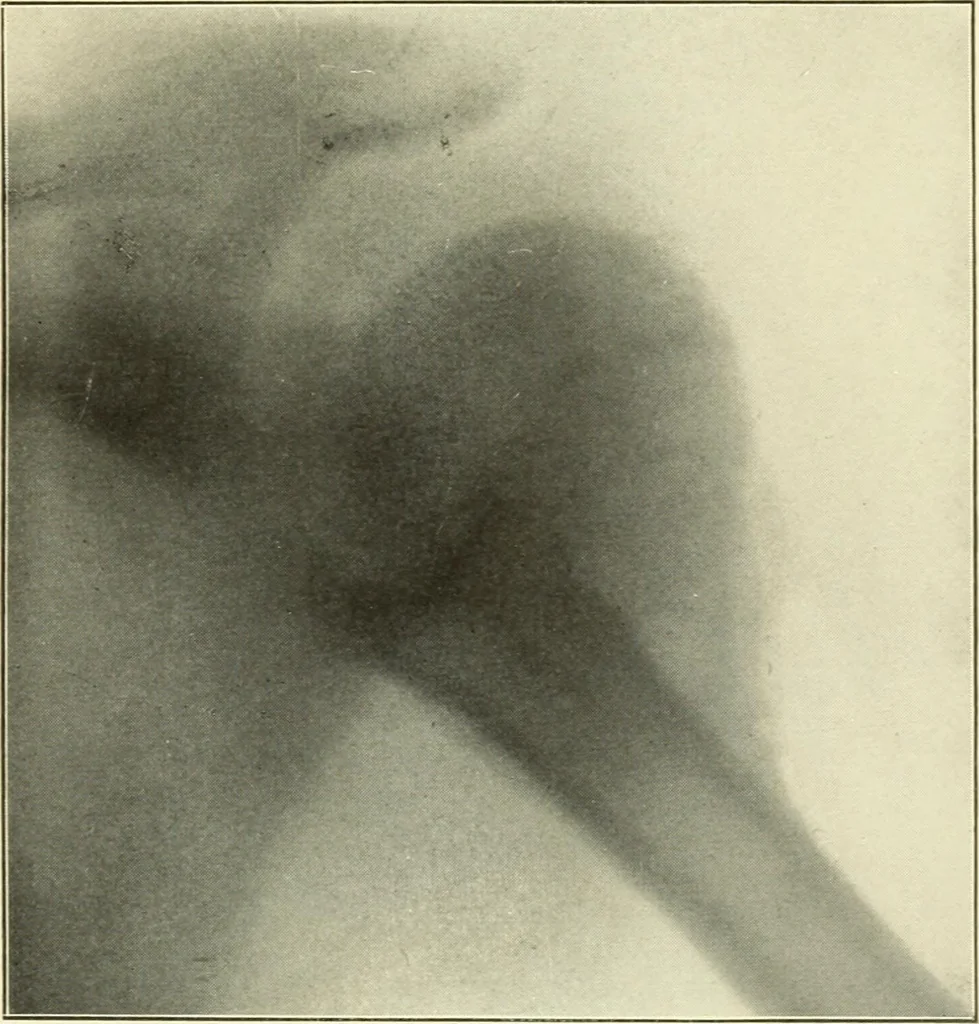 An illustration from Die Röntgenstrahlen im Dienste der Chirurgie, 1902, leaf 158