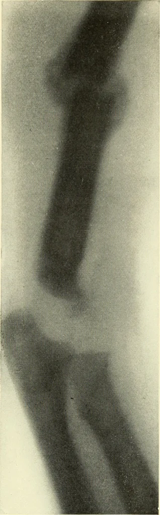 An illustration from Die Röntgenstrahlen im Dienste der Chirurgie, 1902, leaf 160