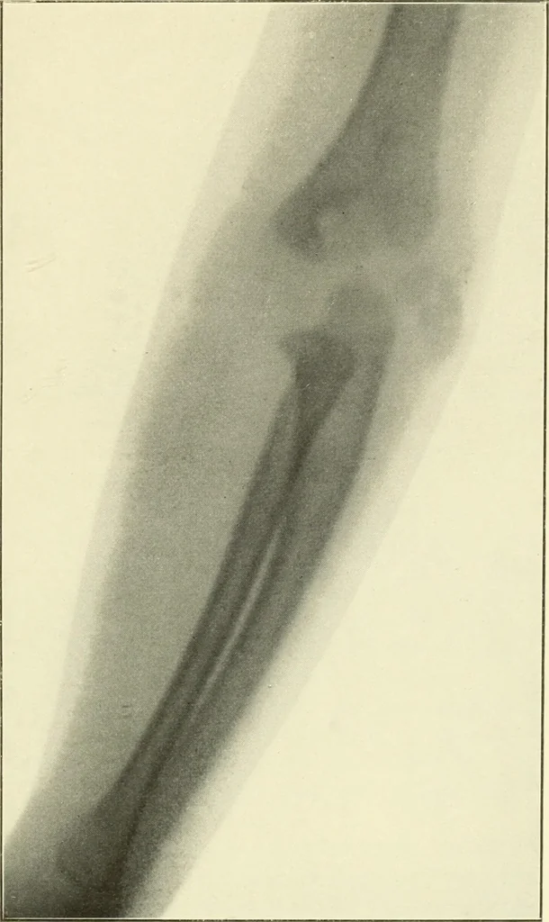 An illustration from Die Röntgenstrahlen im Dienste der Chirurgie, 1902, leaf 166