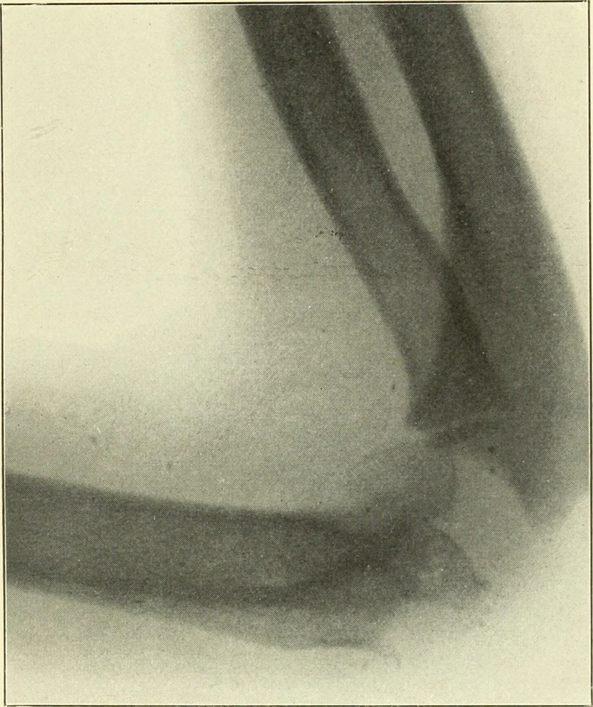 An illustration from Die Röntgenstrahlen im Dienste der Chirurgie, 1902, leaf 170