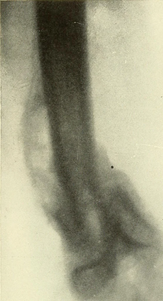 An illustration from Die Röntgenstrahlen im Dienste der Chirurgie, 1902, leaf 172