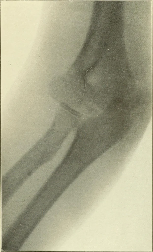 An illustration from Die Röntgenstrahlen im Dienste der Chirurgie, 1902, leaf 174