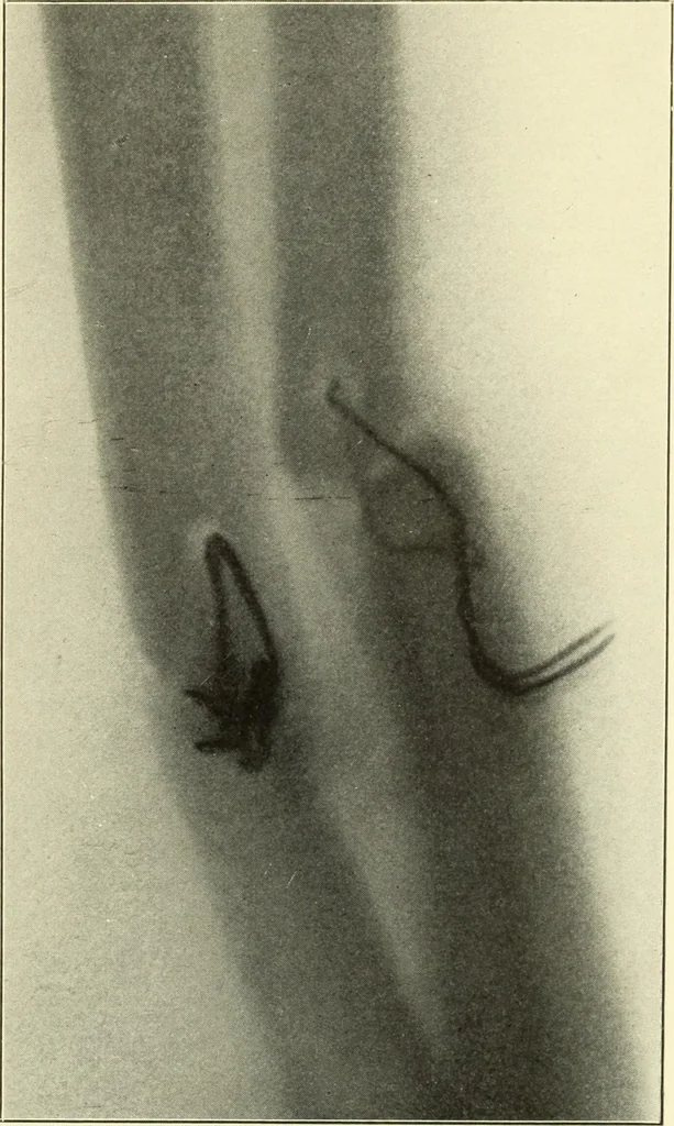 An illustration from Die Röntgenstrahlen im Dienste der Chirurgie, 1902, leaf 186