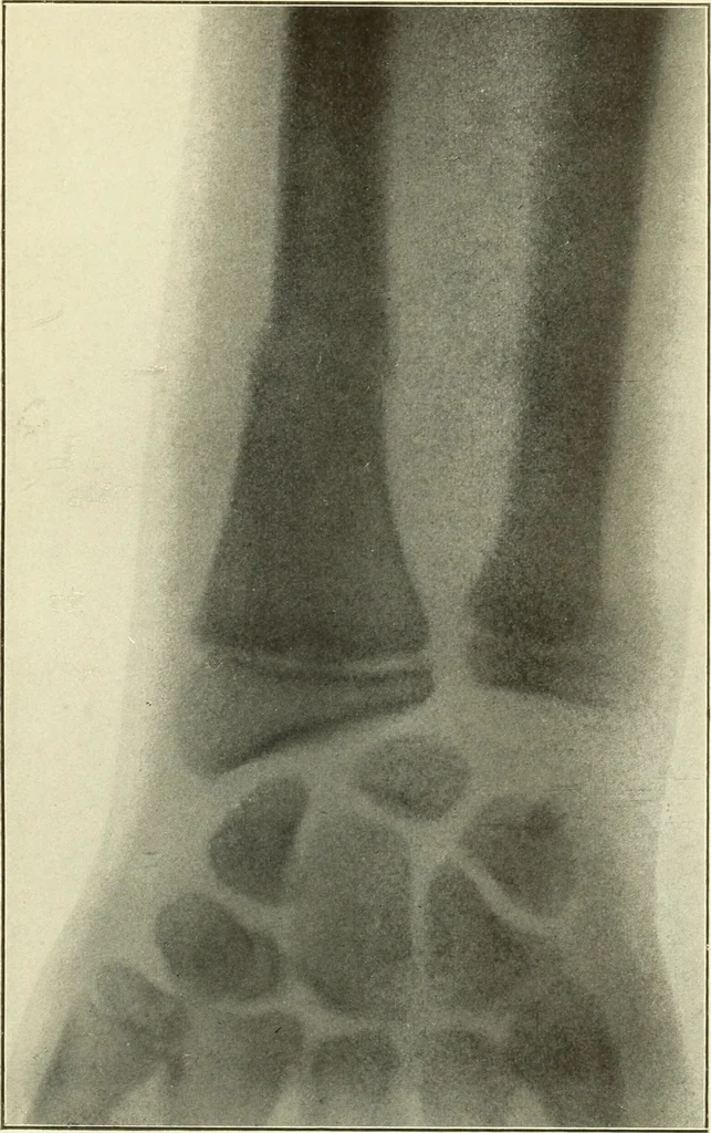 An illustration from Die Röntgenstrahlen im Dienste der Chirurgie, 1902, leaf 192