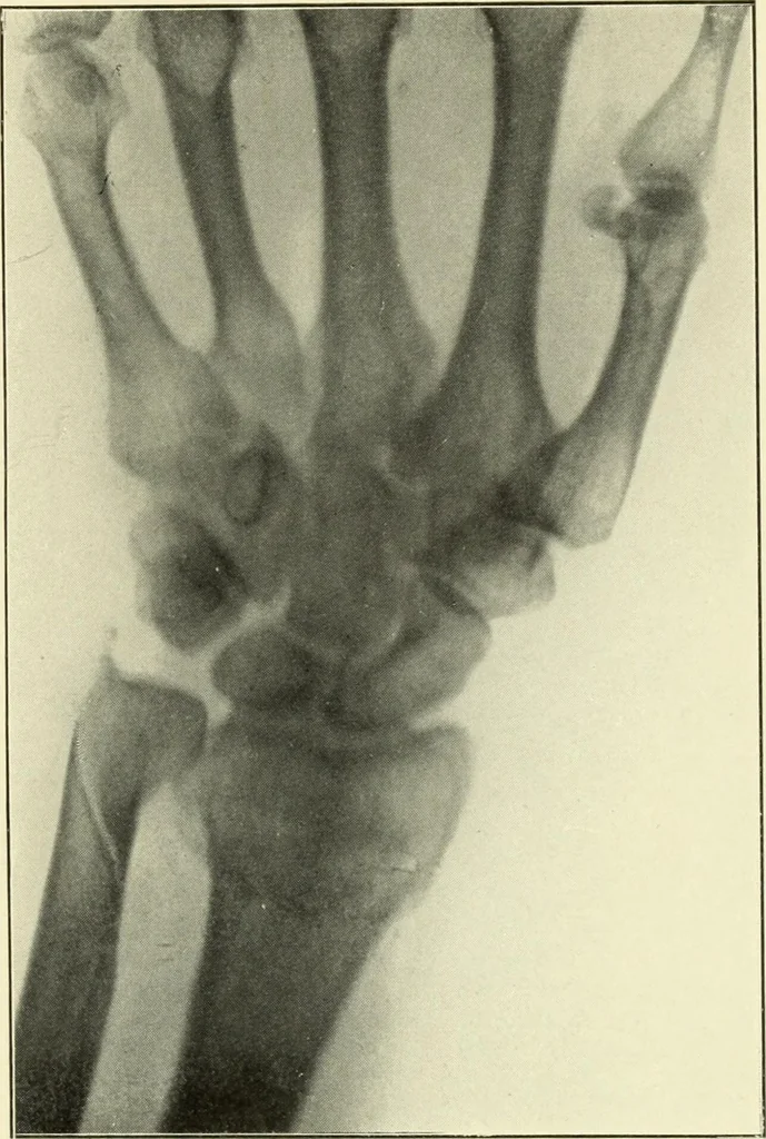 An illustration from Die Röntgenstrahlen im Dienste der Chirurgie, 1902, leaf 194