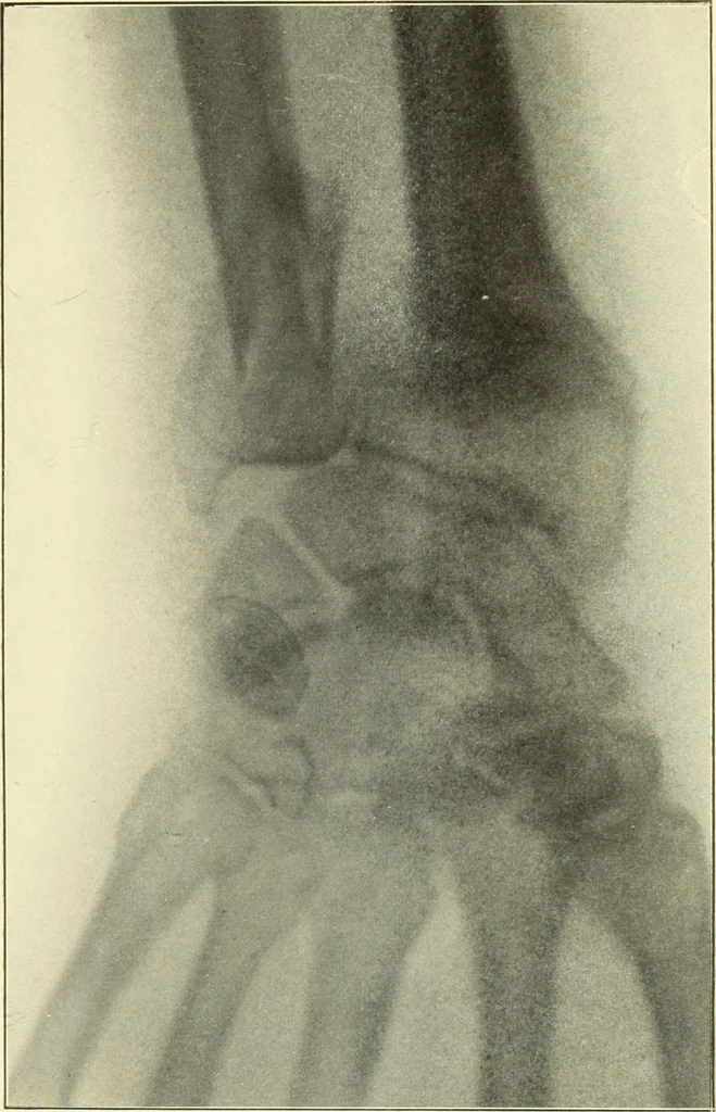 An illustration from Die Röntgenstrahlen im Dienste der Chirurgie, 1902, leaf 196