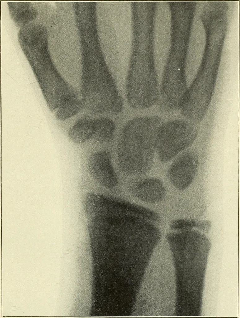 An illustration from Die Röntgenstrahlen im Dienste der Chirurgie, 1902, leaf 200