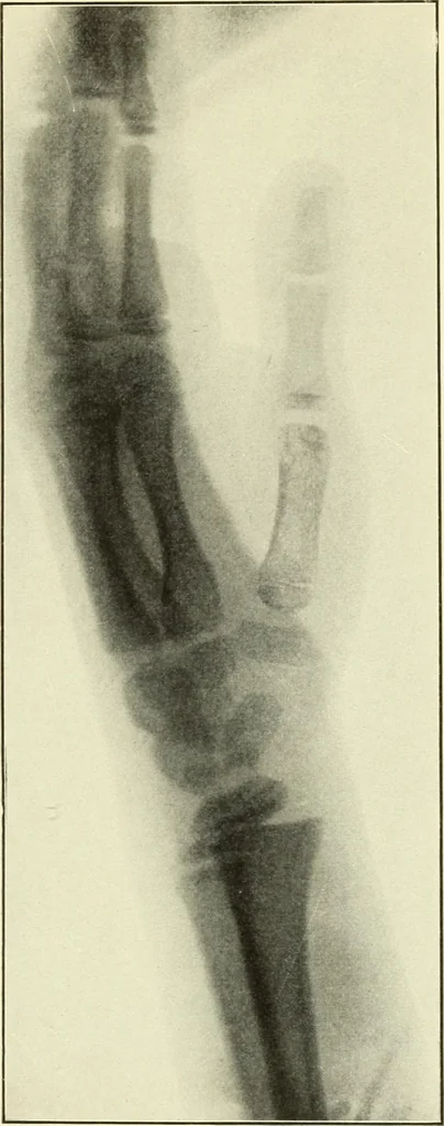 An illustration from Die Röntgenstrahlen im Dienste der Chirurgie, 1902, leaf 202