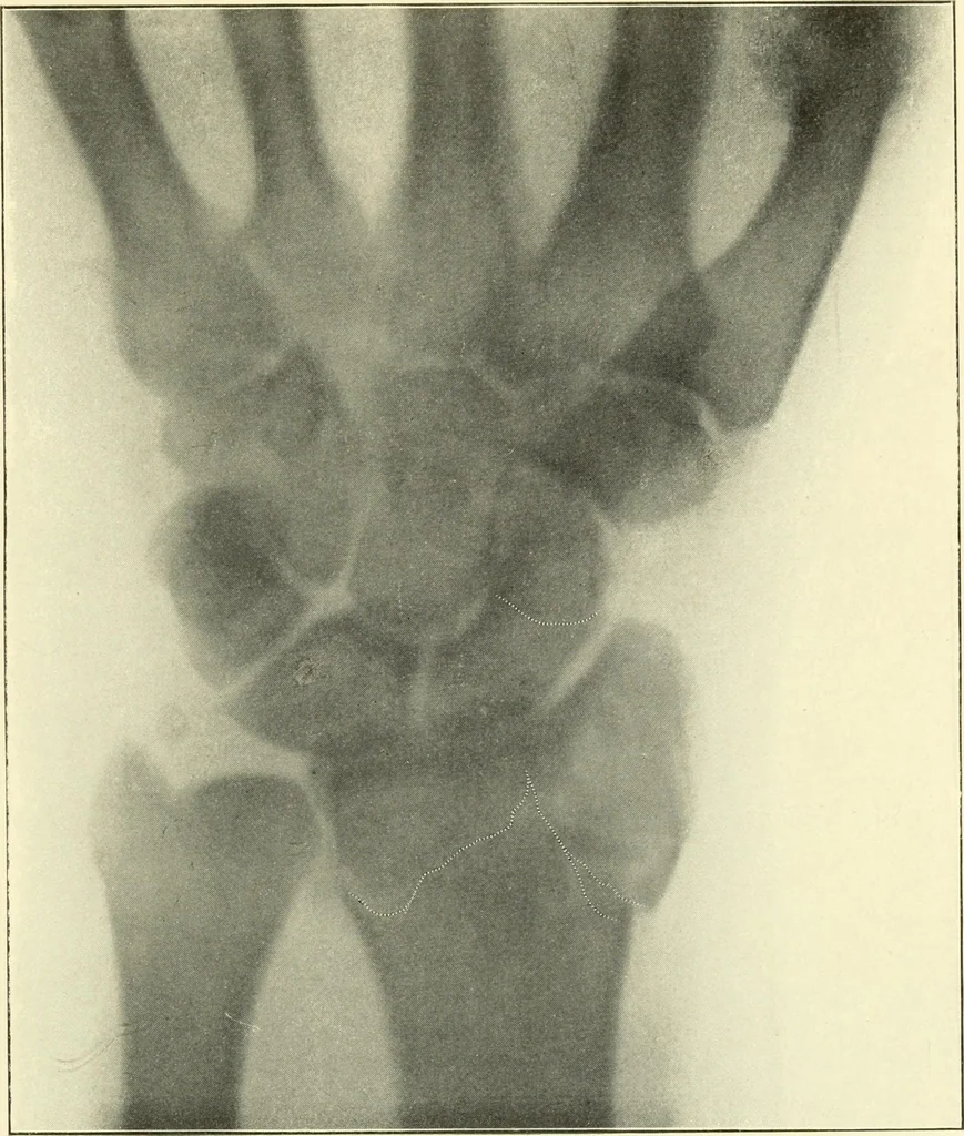 An illustration from Die Röntgenstrahlen im Dienste der Chirurgie, 1902, leaf 204