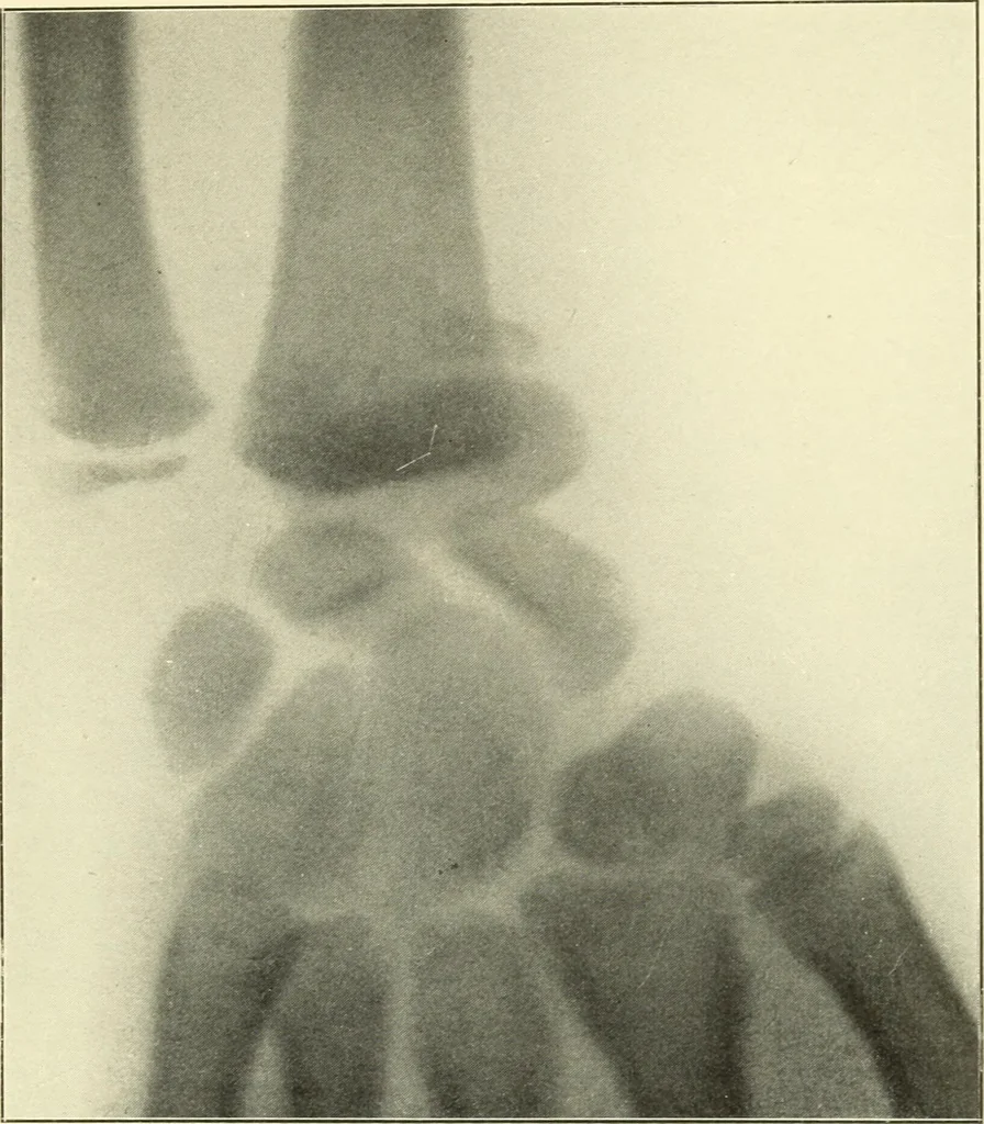 An illustration from Die Röntgenstrahlen im Dienste der Chirurgie, 1902, leaf 212