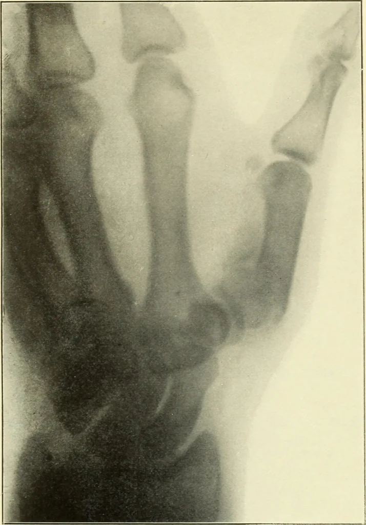 An illustration from Die Röntgenstrahlen im Dienste der Chirurgie, 1902, leaf 218