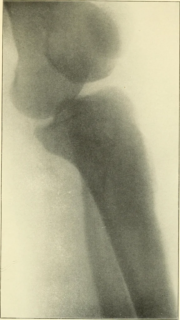 An illustration from Die Röntgenstrahlen im Dienste der Chirurgie, 1902, leaf 226