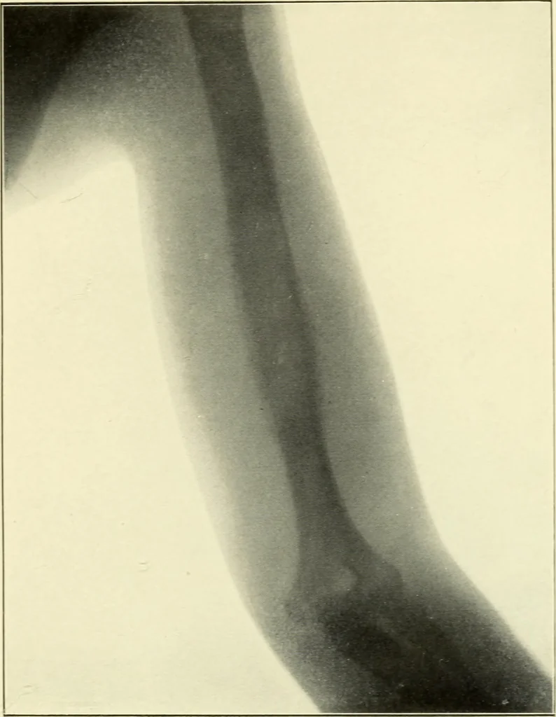 An illustration from Die Röntgenstrahlen im Dienste der Chirurgie, 1902, leaf 230