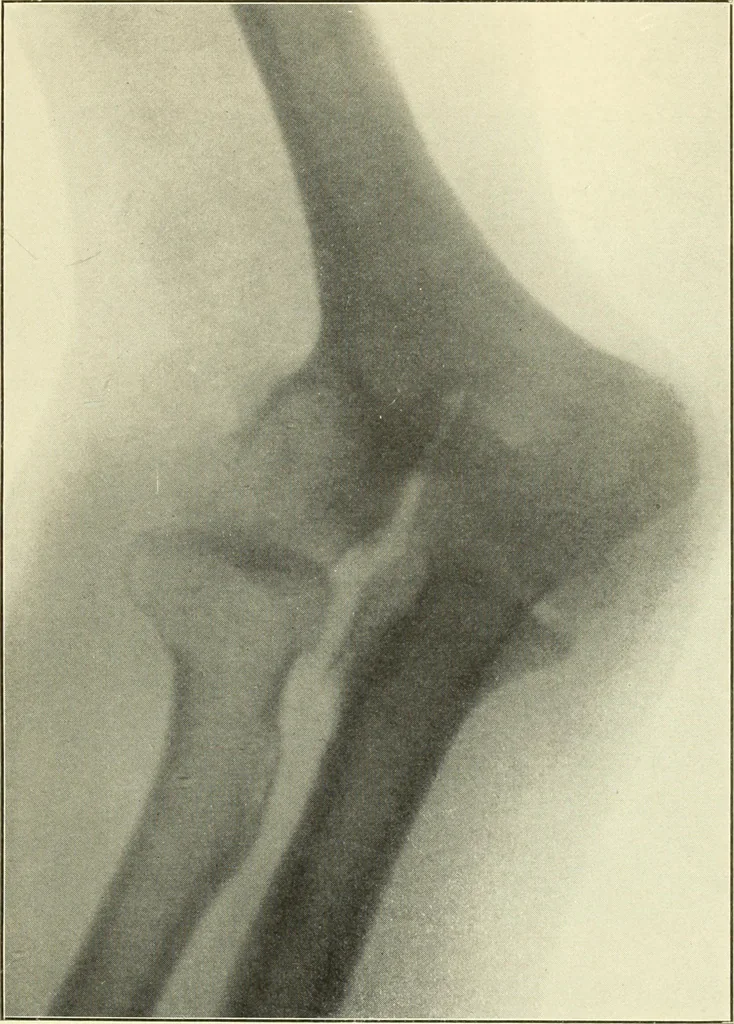 An illustration from Die Röntgenstrahlen im Dienste der Chirurgie, 1902, leaf 236