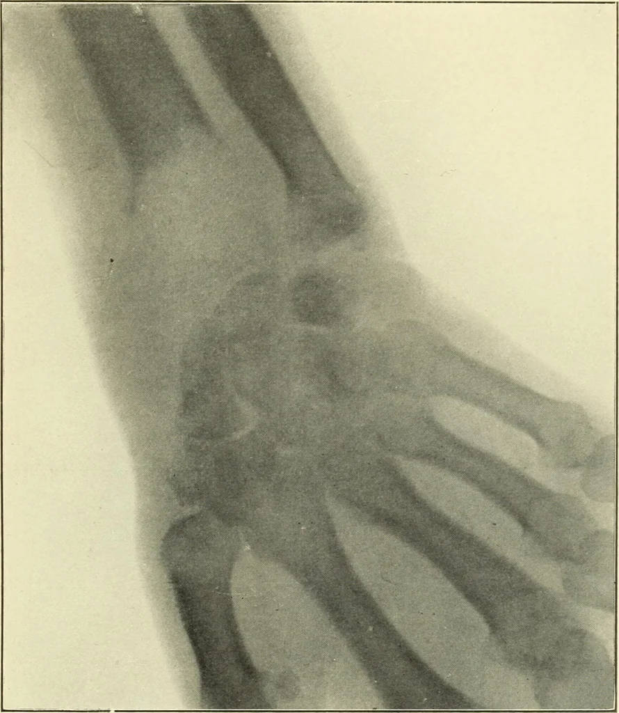 An illustration from Die Röntgenstrahlen im Dienste der Chirurgie, 1902, leaf 242