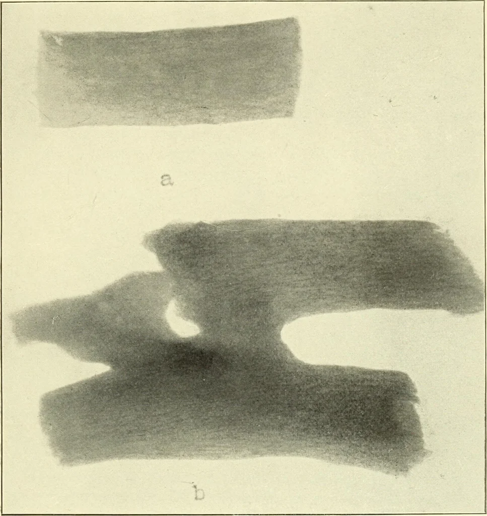 An illustration from Die Röntgenstrahlen im Dienste der Chirurgie, 1902, leaf 248