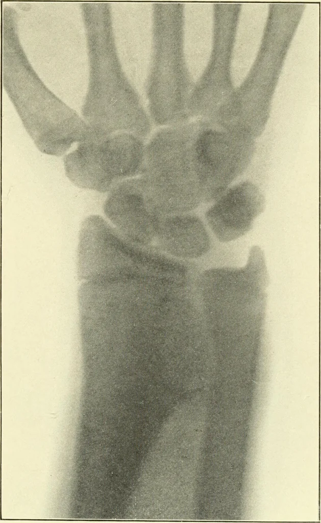 An illustration from Die Röntgenstrahlen im Dienste der Chirurgie, 1902, leaf 252