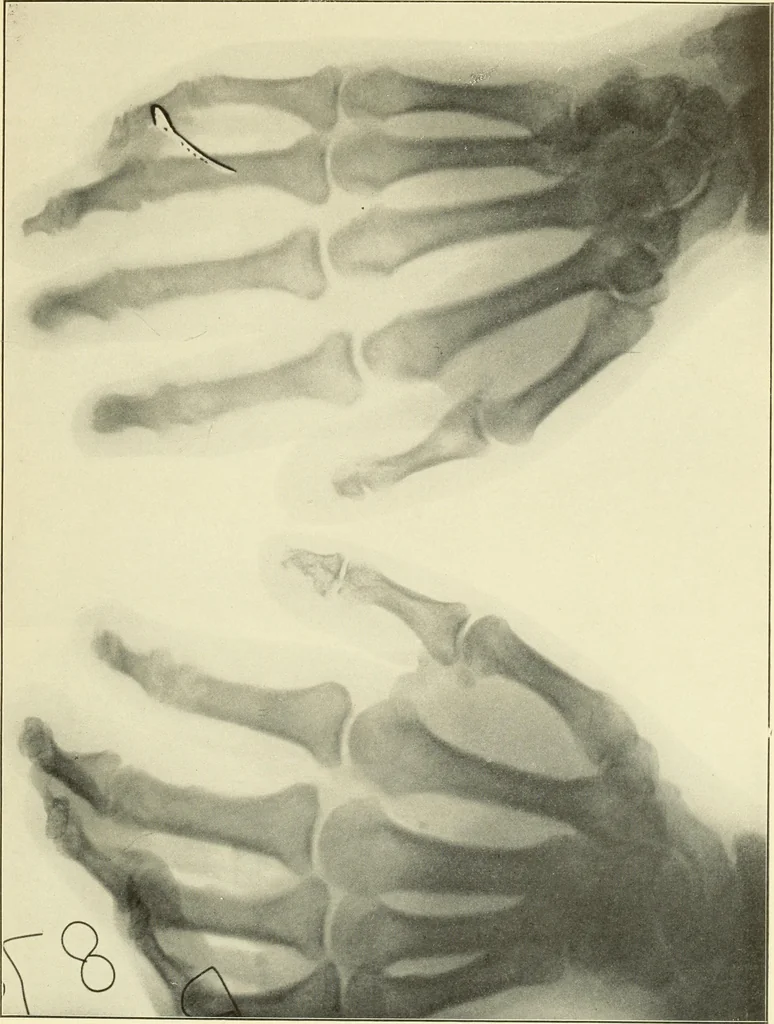 An illustration from Die Röntgenstrahlen im Dienste der Chirurgie, 1902, leaf 254