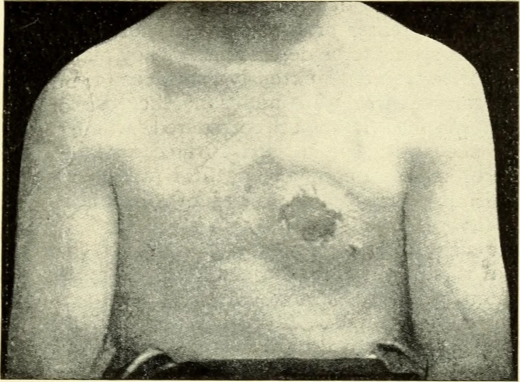 An illustration from Die Röntgenstrahlen im Dienste der Chirurgie, 1902, leaf 262