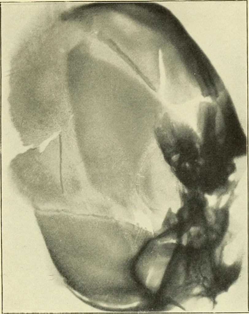 An illustration from Die Röntgenstrahlen im Dienste der Chirurgie, 1902, leaf 46