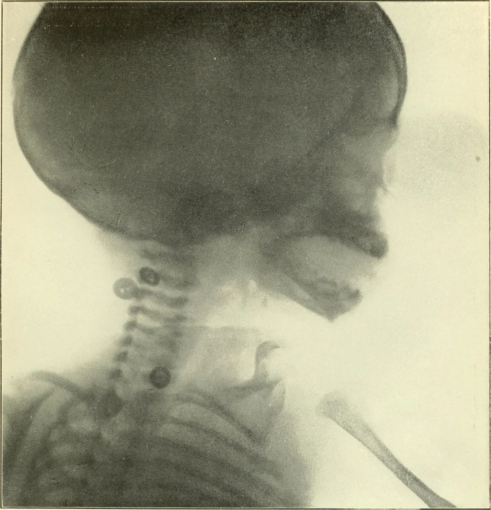 An illustration from Die Röntgenstrahlen im Dienste der Chirurgie, 1902, leaf 50