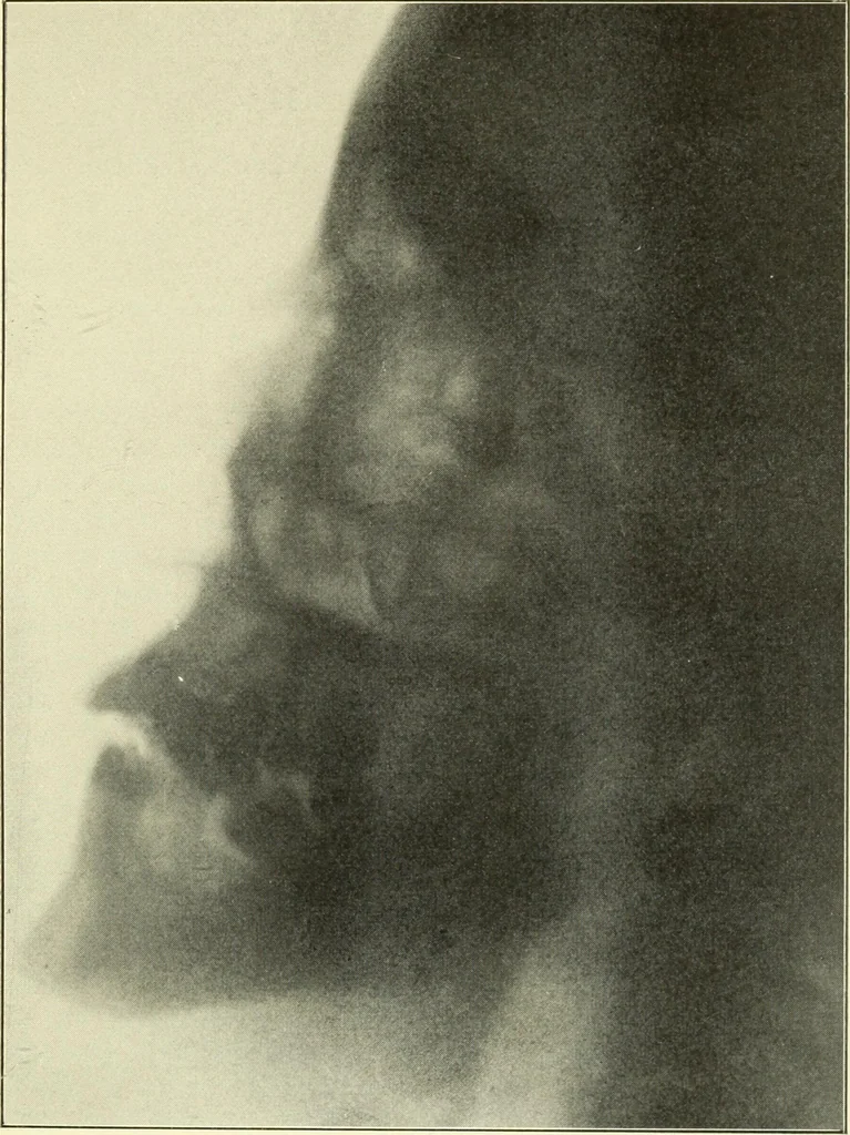 An illustration from Die Röntgenstrahlen im Dienste der Chirurgie, 1902, leaf 56