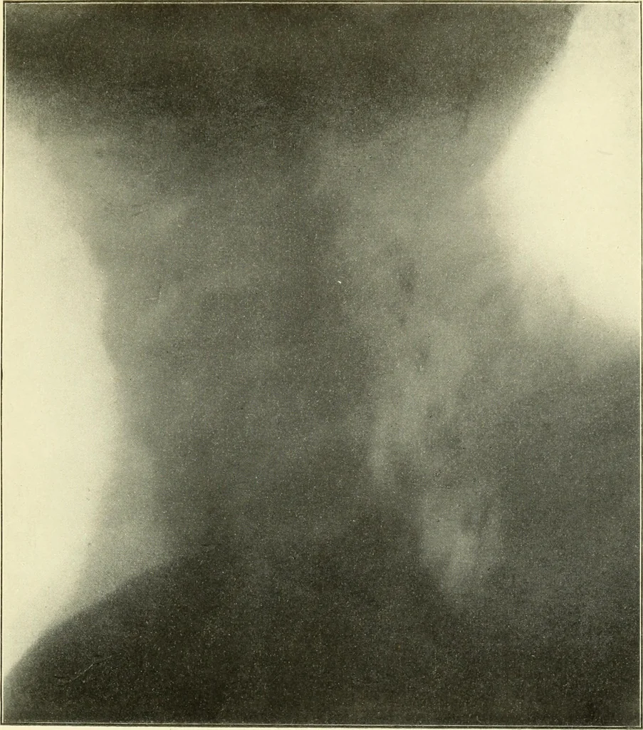 An illustration from Die Röntgenstrahlen im Dienste der Chirurgie, 1902, leaf 62