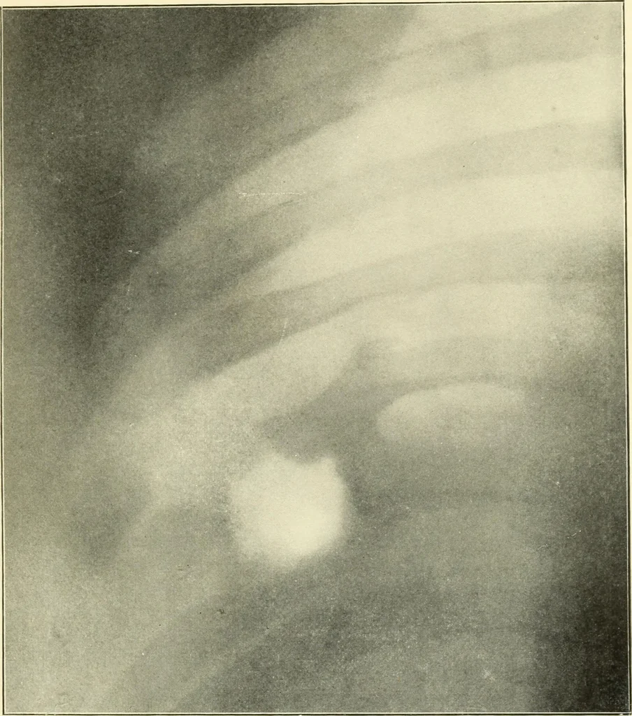 An illustration from Die Röntgenstrahlen im Dienste der Chirurgie, 1902, leaf 78
