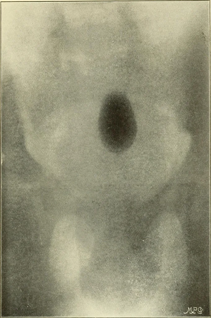 An illustration from Die Röntgenstrahlen im Dienste der Chirurgie, 1902, leaf 96
