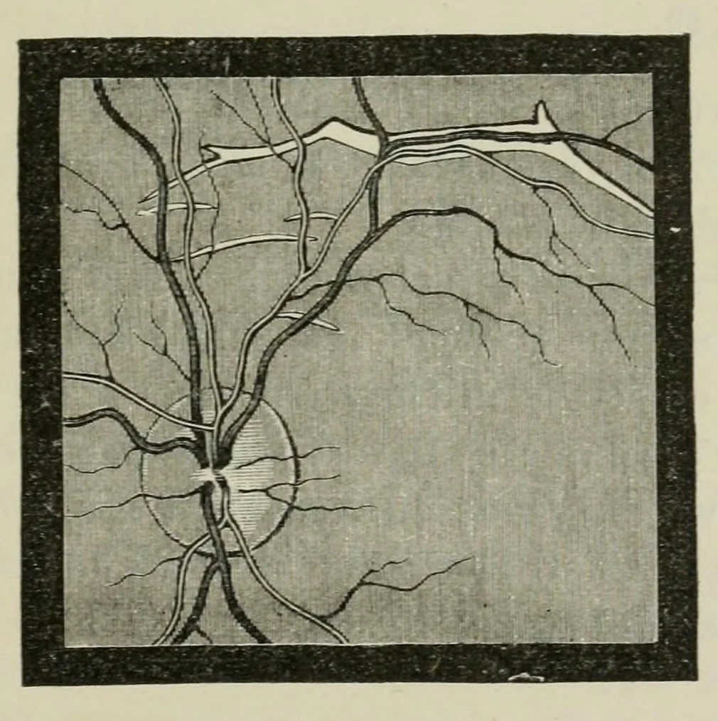 An illustration from Diseases of the eye., 1890, leaf 219