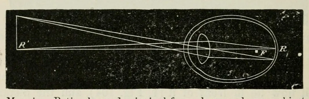 An illustration from Diseases of the eye., 1890, leaf 330