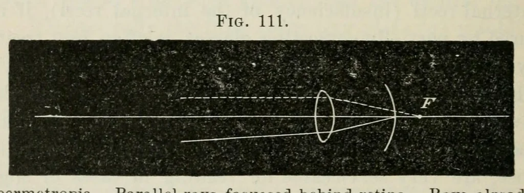 An illustration from Diseases of the eye., 1890, leaf 342