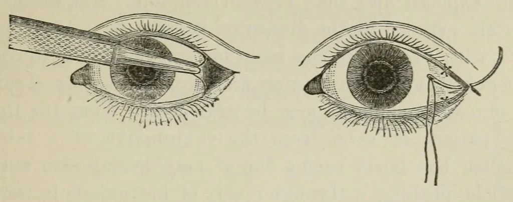 An illustration from Diseases of the eye., 1890, leaf 393