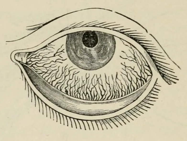An illustration from Diseases of the eye., 1890, leaf 56