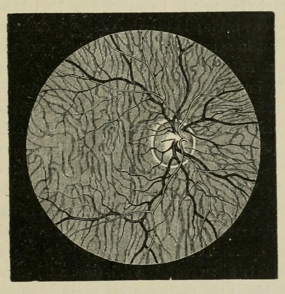 An illustration from Diseases of the eye., 1890, leaf 75