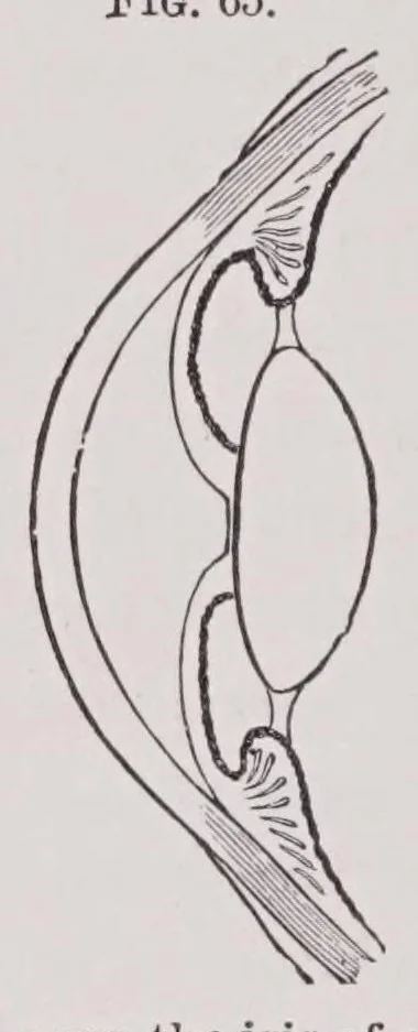 An illustration from Diseases of the eye, 1900, leaf 166